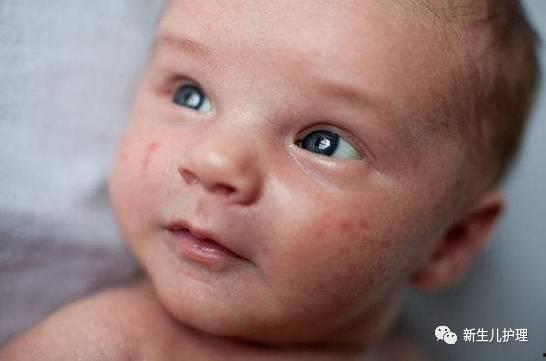 吃瓢瓜过敏怎办,紧急处理与预防措施指南